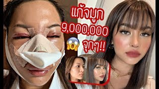 NOSE SURGERY VLOG ศัลยกรรมแก้จมูกที่เกาหลี จมูกเบี้ยว หมอจะปั้นได้มั้ยยยย?! (VVALENTINES)