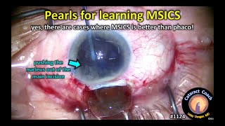 CataractCoach 1124: pearls for learning MSICS: manual small incision cataract surgery