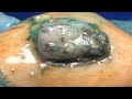 sharp ingrown trimmed professional pedicure dr lee’s ultimate zitpopper 無心で見れる動画 m81912 3420