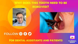 Why does this tooth need to be removed?