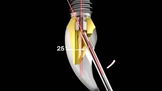 プロセティックキット - アングルドライバー (Prosthetic Kit - Angle Driver)