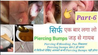 Piercing Bumps, Yellow, White pus, Bleeding गायब करने का आसान व घरेलू उपाय Home Remedies l Part-6 l