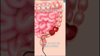 This Is What Happens During a Colonoscopy!