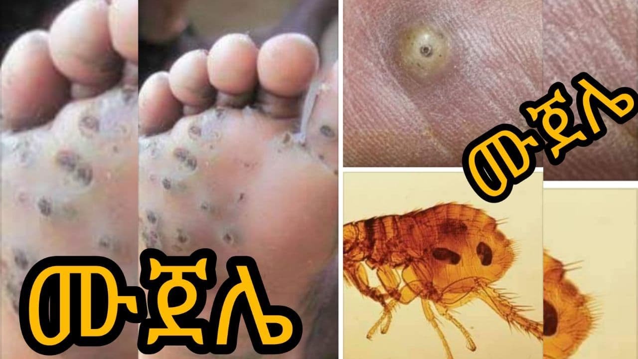 #DefeatNTDs Tungiasis (ሙጀሌ), A Neglected Tropical Skin Disease, By ...