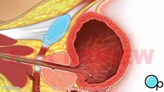 TURBT Transurethral Resection of Bladder Tumor, Male PreOp Patient Education