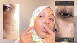 Sidee kuyareen kartaa dul duleeka wajiga. ( how to reduce pores on the face)