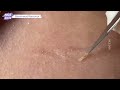 lips blackhead removal video 53 blackheads blackheadsremoval sebum