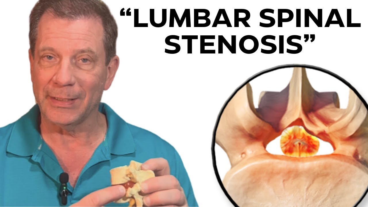 7 Step Non-Surgical Treatment For Lumbar Spinal Stenosis | Dr. John ...