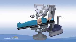 da Vinci Single-Site Cholecystectomy (Gallbladder Surgery)
