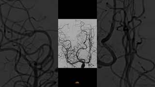 AVM  with bleed: Embolization technique