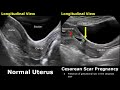 C-Section Uterus Ultrasound Normal Vs Abnormal Image Appearances | Cesarean Scar Complications USG