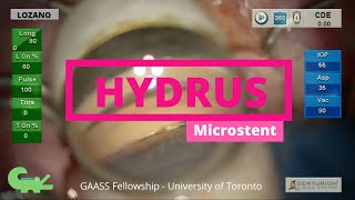 Implantation of a Hydrus Microstent