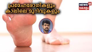 Dr Q |  പ്രമേഹരോഗികളും കാലിലെ മുറിവുകളും Diabetic Foot Ulcer | 16th November 2019