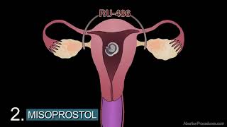 How Does the Abortion Pill Work: 1st Trimester Medical Abortion Video