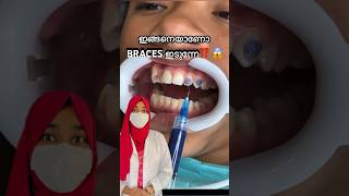 ഇങ്ങനെയാണോ പല്ലിൽ കമ്പി ഇടുന്നേ😱⁉️ #dentist #malayalam #braces #viral #youtubeshorts