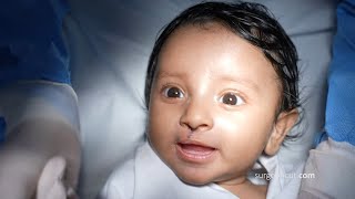 Cleft Lip Correction Surgery for a Cute Boy Baby | Cleft Lip Surgery Vlog