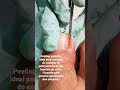 tratamento peeling químico para onicofose /   Nilza Garcia Podóloga #podologia