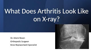 What Does Arthritis Look Like on X-ray