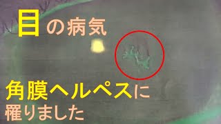 【角膜ヘルペス(1/2)】目にヘルペスができていると眼科で診断され、治療を始めてから1週間のご報告。