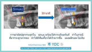 จะทำรากฟันเทียม แต่ต้องยกไซนัสแล้วปลูกกระดูก ขั้นตอนเป็นยังไง