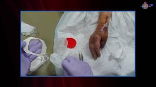 WCW: Novel Management of a Heavily Draining Wound