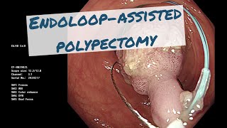 Endoloop-assisted polypectomy การตัดติ่งเนื้อลำไส้ใหญ่