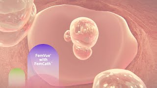 FemVue with FemCath Animation