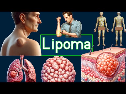 What are lipomas composed of?