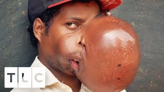 Can Surgery Help Remove This Boy's Life-Threatening Fibroma? | Body Bizarre