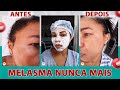 Como acabar com o melasma - tratamento veja /Vânia Santos MK