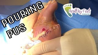 Pus Pouring Out of Amputated Toe