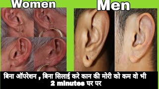 How to reduce ear hole size at Home