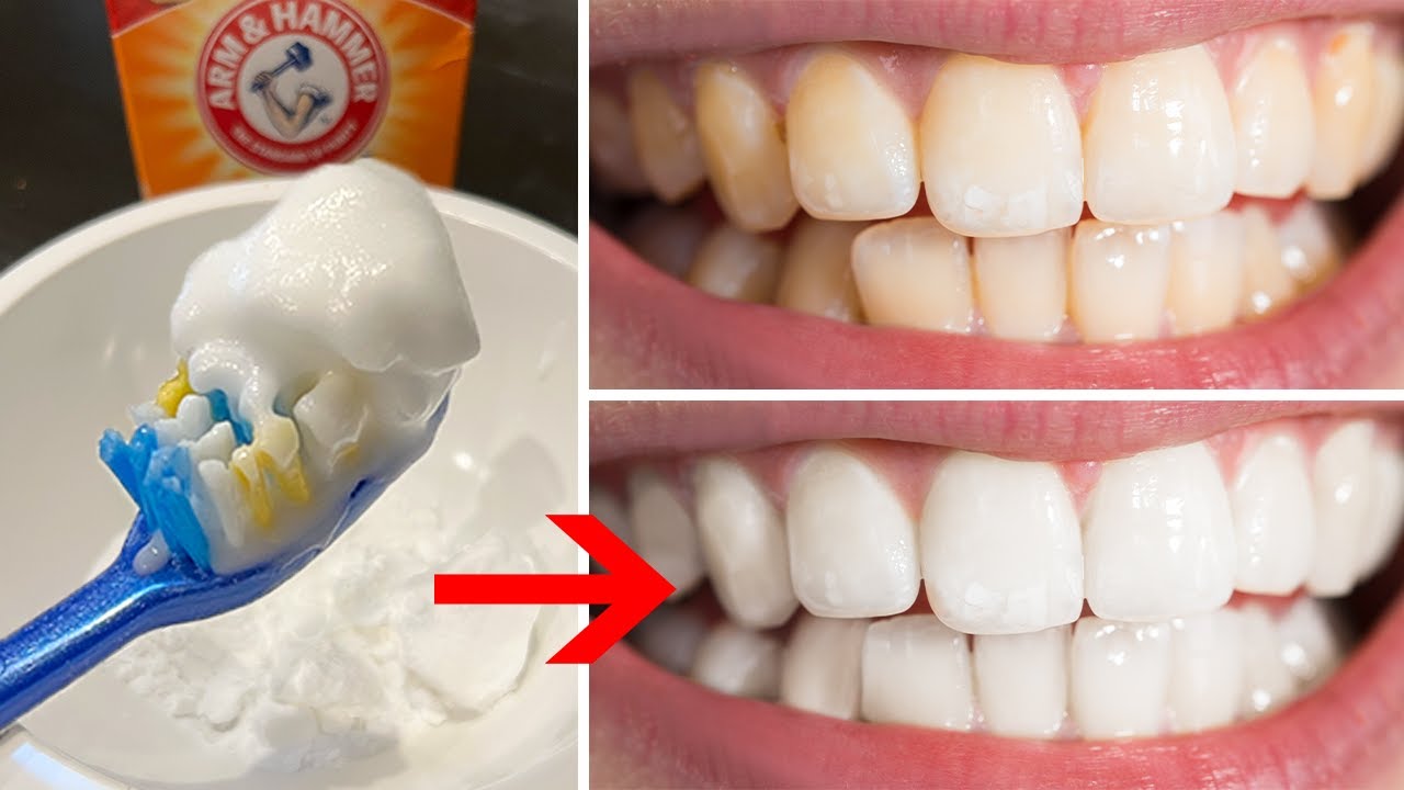 Teeth Whitening Home Remedies & DIY Hacks (Fast, Natural, & Affordable ...