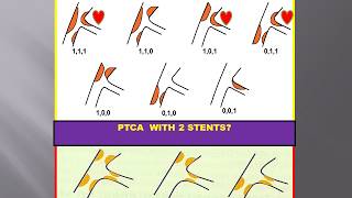 CORONARY ARTERY BIFURCATION LESION,INTERVENTIONAL TECHNIQUE.  KASTANIS BIFURCATIONS