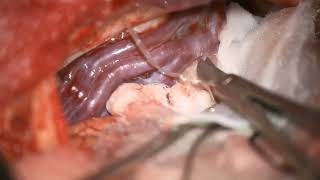 Brain Aneurysm: Minimally Invasive Keyhole Surgery for an unruptured left ICA bifurcation aneurysm