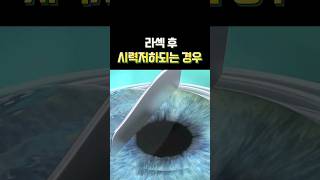 라섹 후 시력저하되는 경우