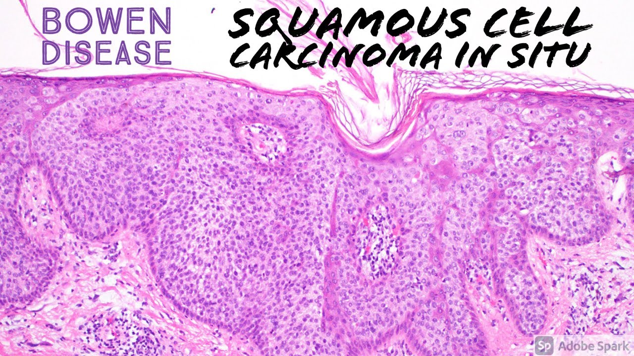 Squamous Cell Carcinoma In Situ Histology