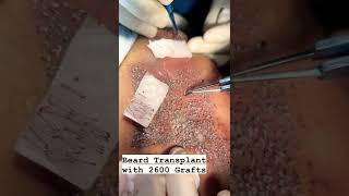 Beard transplant for a teenager | 2600 grafts | Beard transplant in Mumbai |  Beard Specialist