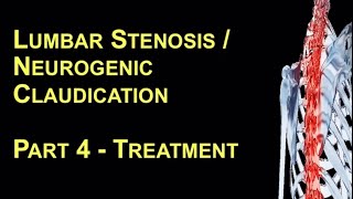 Lumbar Stenosis / Neurogenic Claudication. Part 4:Treatment. Zeeshan Sardar, Spine/Scoliosis Surgeon