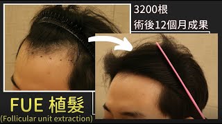 【韓國植髮分享】  FUE 植髮│3200根│術后12個月成果│Hair transplant in korea│FUE follicular unit extraction │Result