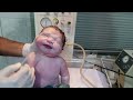 new born baby big man look like hulk weight is 4.5 kg in lbs 9.9 baby save sevre obstruction air way