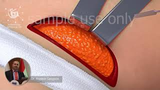 Butt Implants Procedure|Buttock Augmentation Surgery|medical animation|sample use only