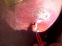 pus plug removal with happy ending