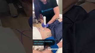 Slimpspec- Tattoo removal expediting