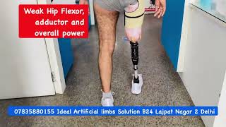 nakali 07835880155 weak hip muscles power | Above knee prosthesis with Capital knee joint