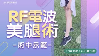 【RF電波美腿術】消除蘿蔔腿，纖纖腿計畫｜專家團隊安全把關｜曾偉琦醫師｜萊波亞美醫診所