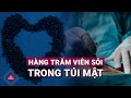 Khủng khiếp hình ảnh hành trăm viên sỏi trong túi mật một người phụ nữ ở Phú Thọ | VTC Now