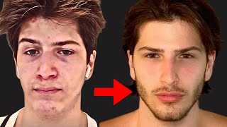 Every Looksmaxxing Method Explained in 7 Minutes