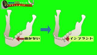 インプラントガイドを３Dプリンターを使って製作する