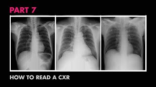 Cardiac Silhouette - How to Read a Chest X-Ray (Part 7) - MEDZCOOL